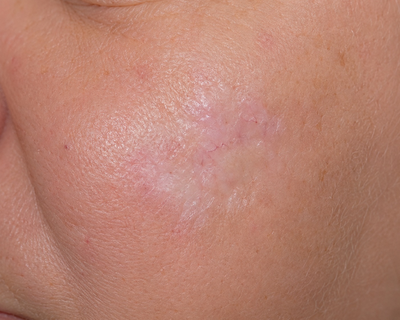 Morphoeic BCC, cheek