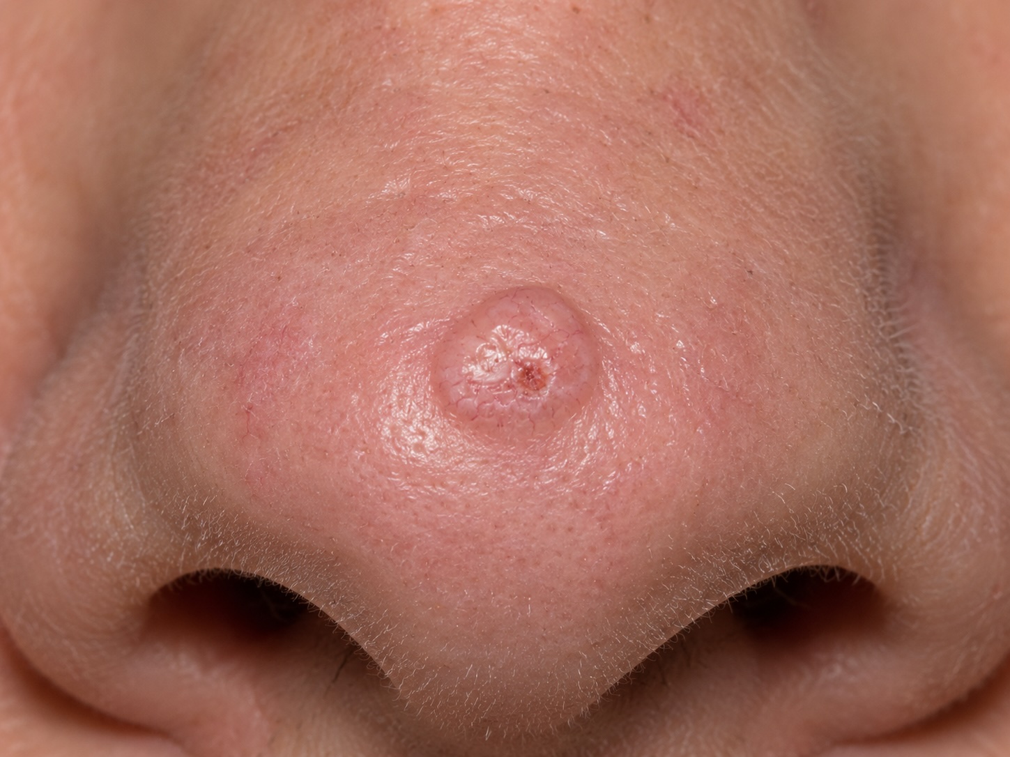 Nodular BCC, nose tip, Fitz II