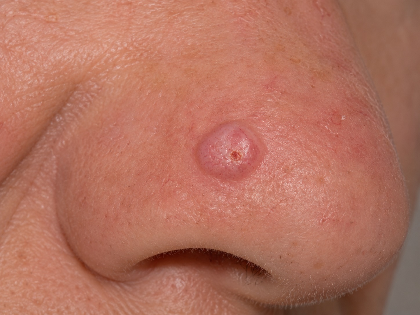 Nodular BCC