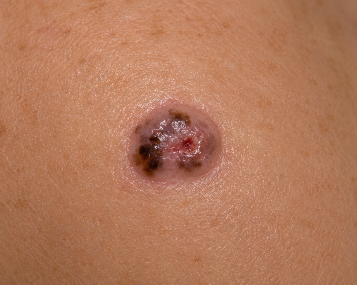 Pigmented BCC