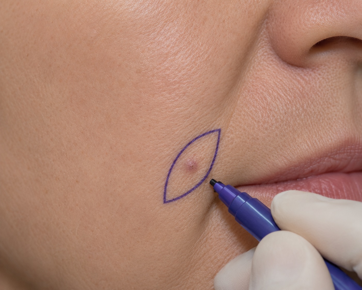 BCC excision marking, nasolabial fold