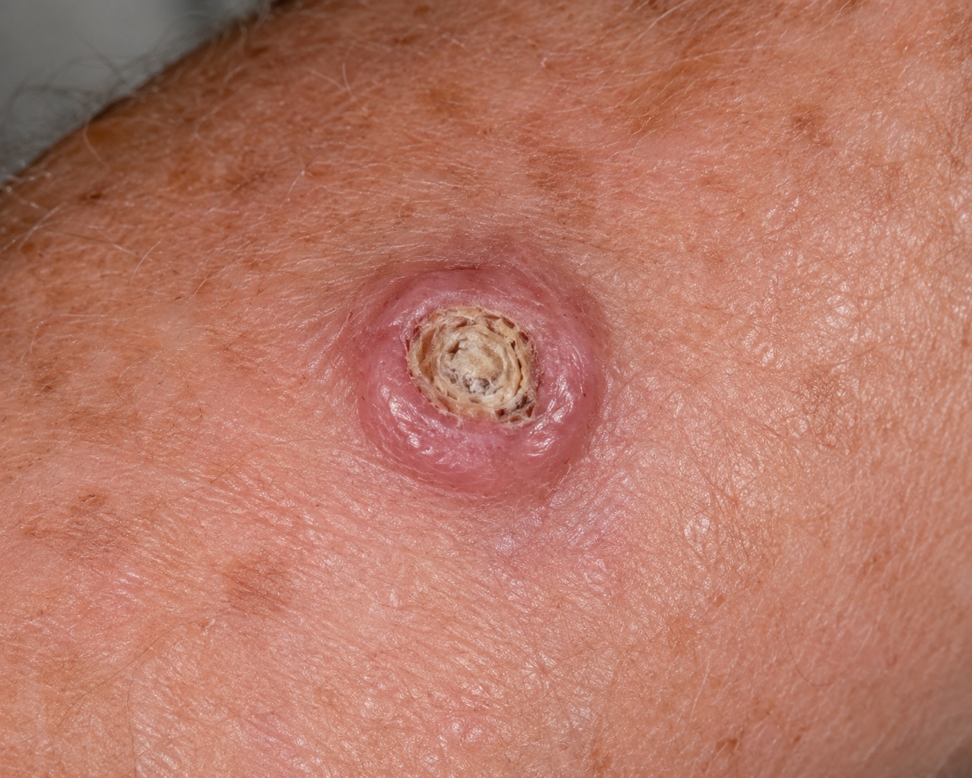 Keratoacanthoma vs cSCC