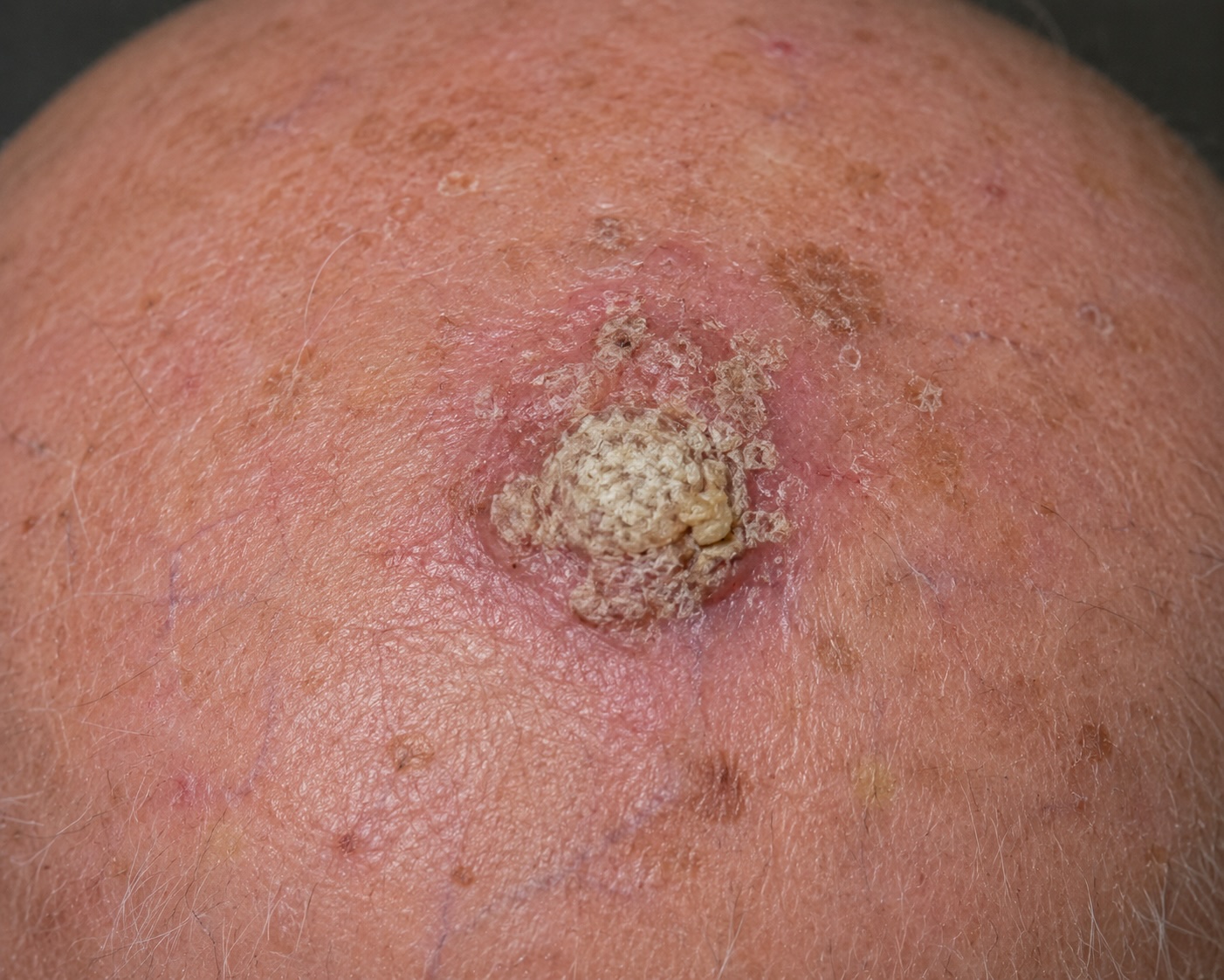 Scalp cSCC, hyperkeratotic