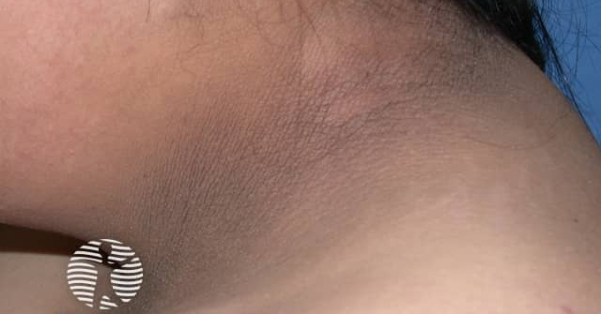 Clinical image of Acanthosis nigricans