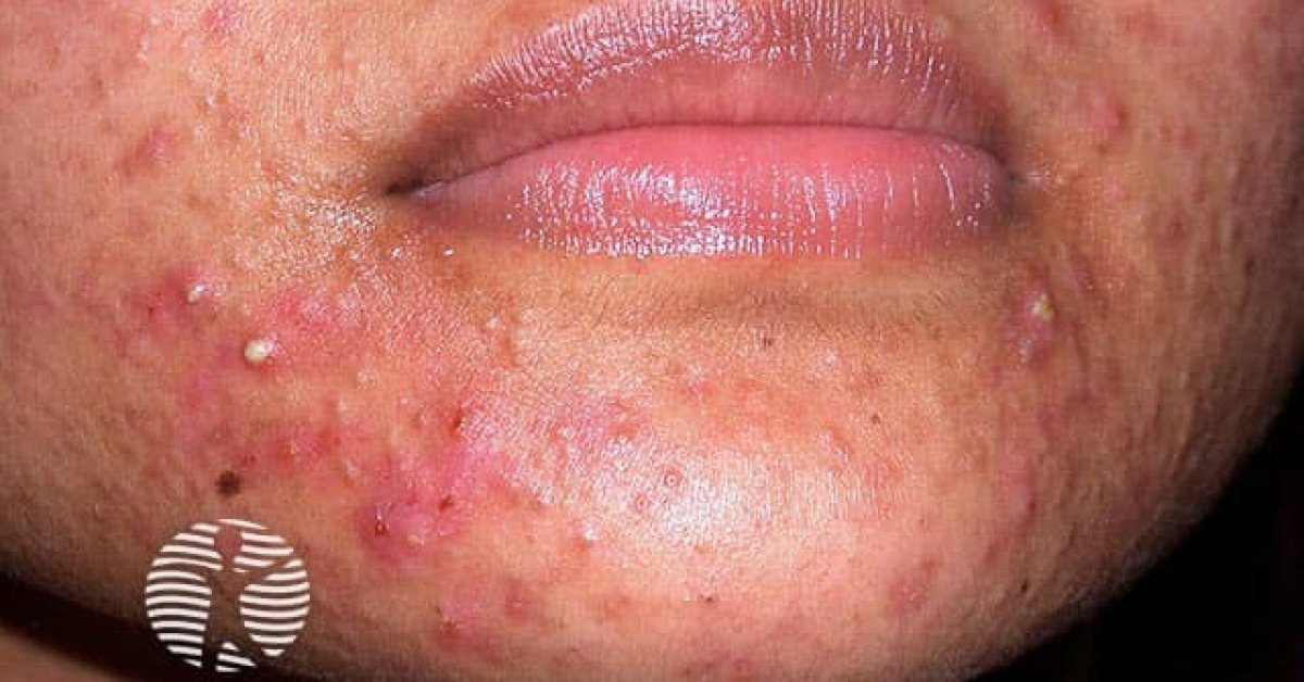 Clinical image of Acne vulgaris