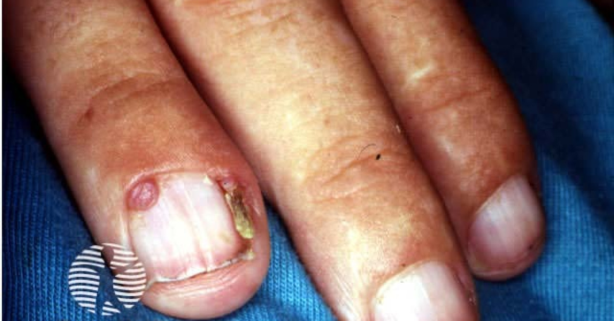 Clinical image of Acquired digital fibrokeratoma