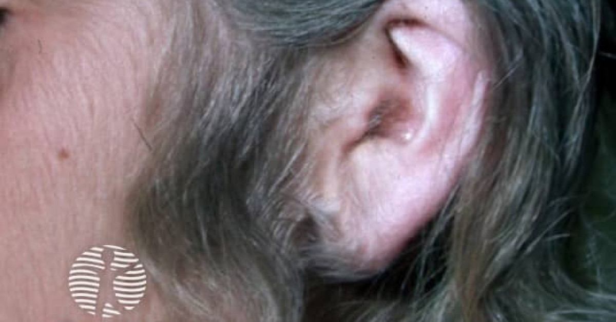 Clinical image of Acquired hypertrichosis lanuginosa