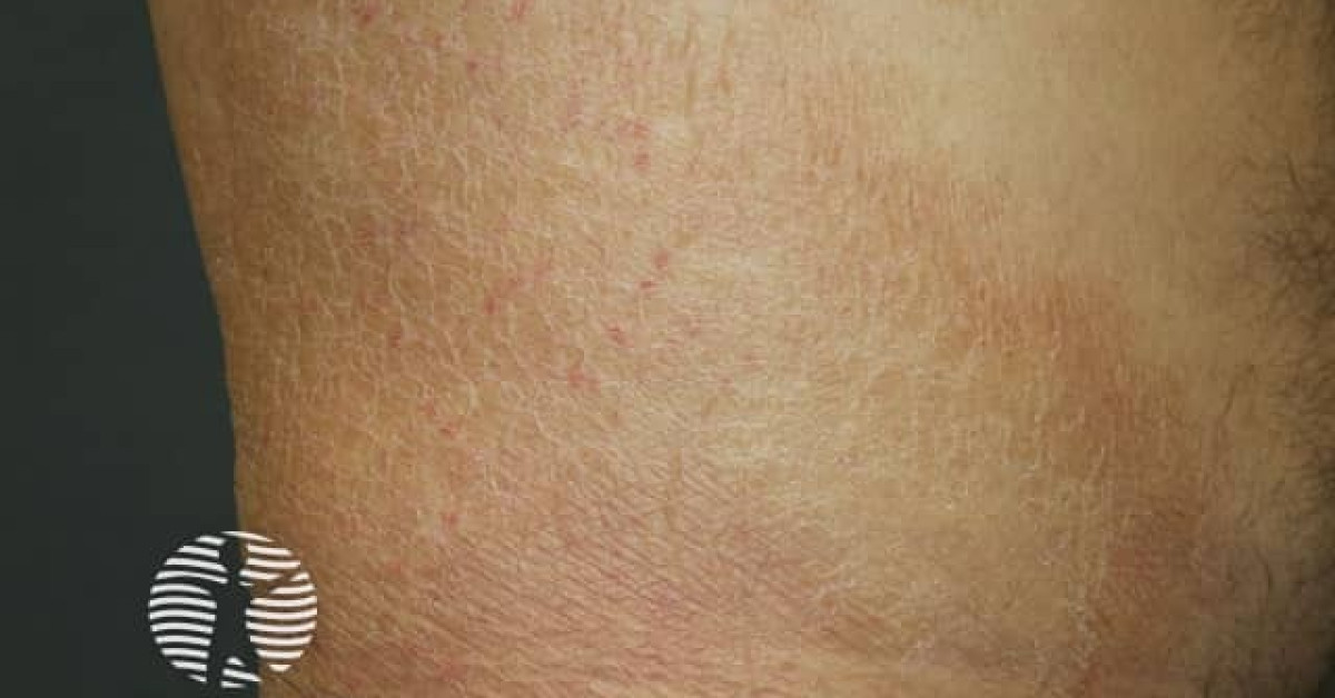 Clinical image of Acquired ichthyosis