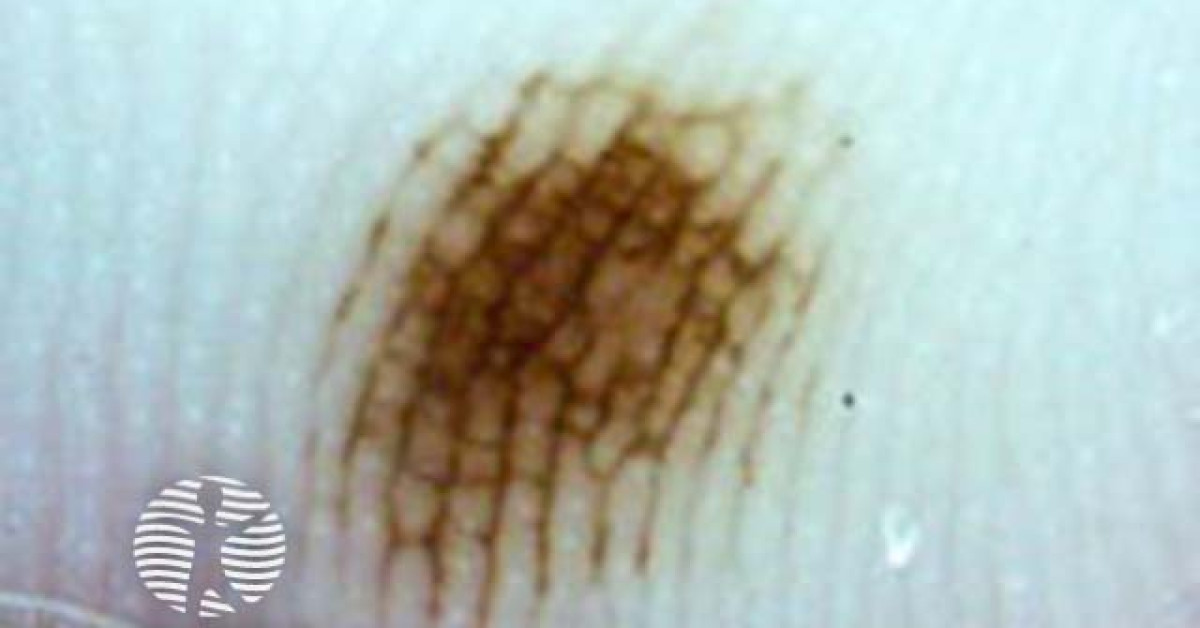 Clinical image of Acral melanocytic naevi