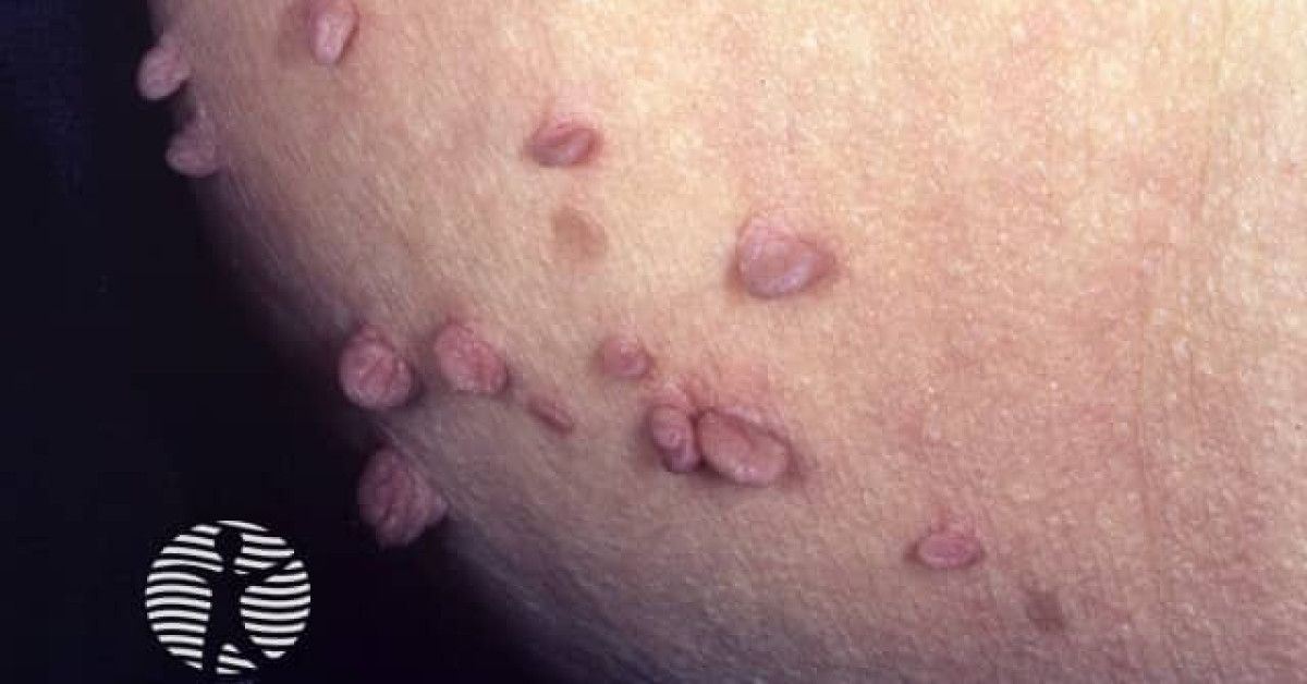 Clinical image of Acrochordon (skin tag)