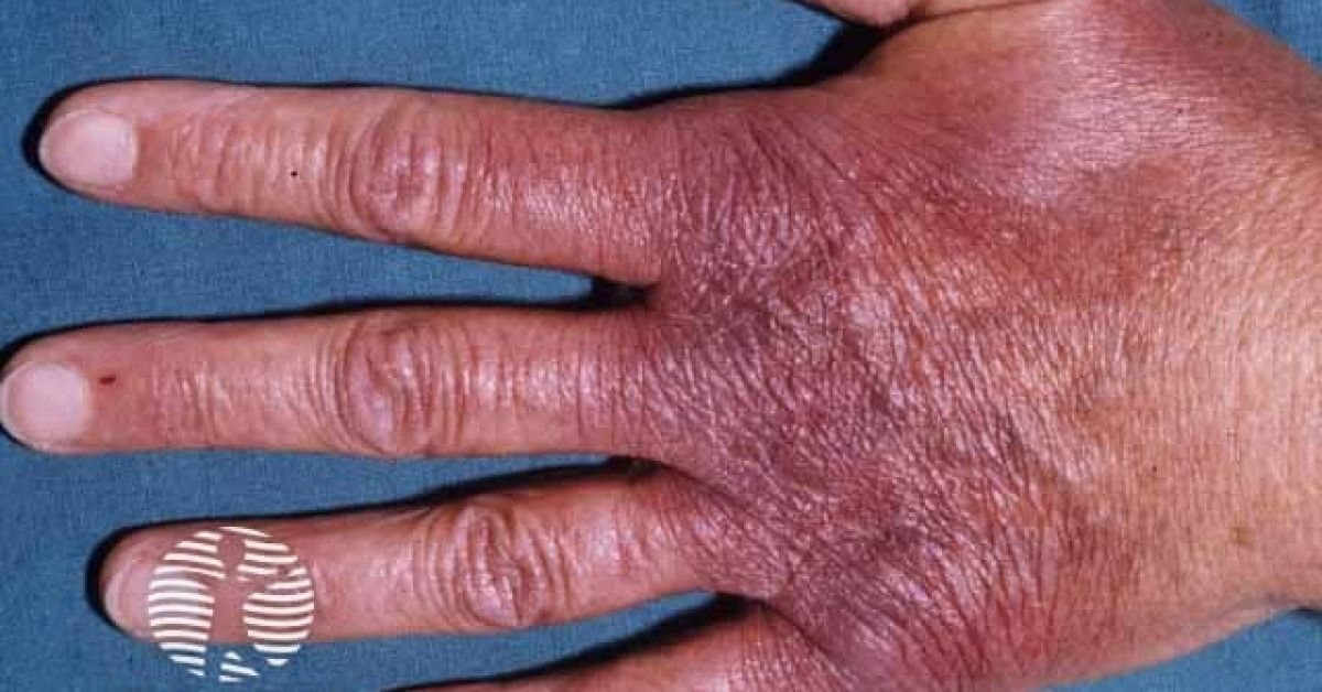 Clinical image of Acrodermatitis chronica atrophicans