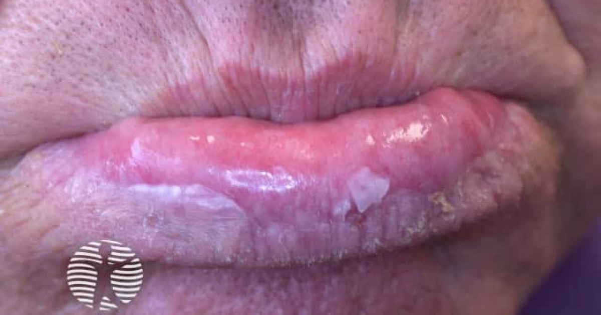 Clinical image of Actinic cheilitis