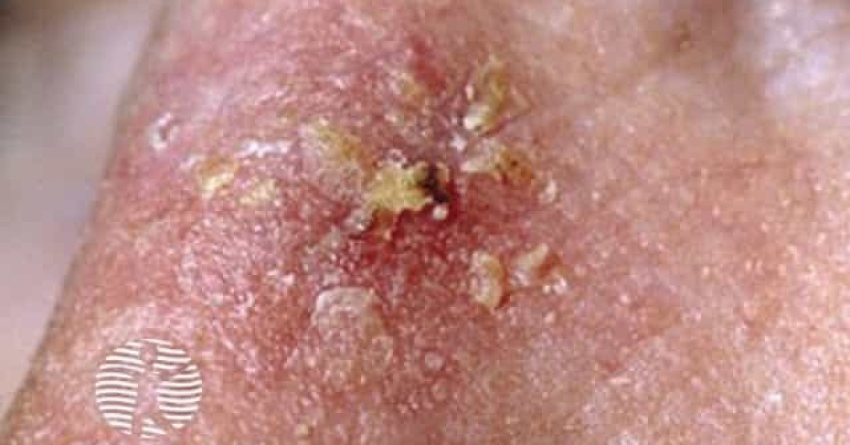 Clinical image of Actinic keratosis