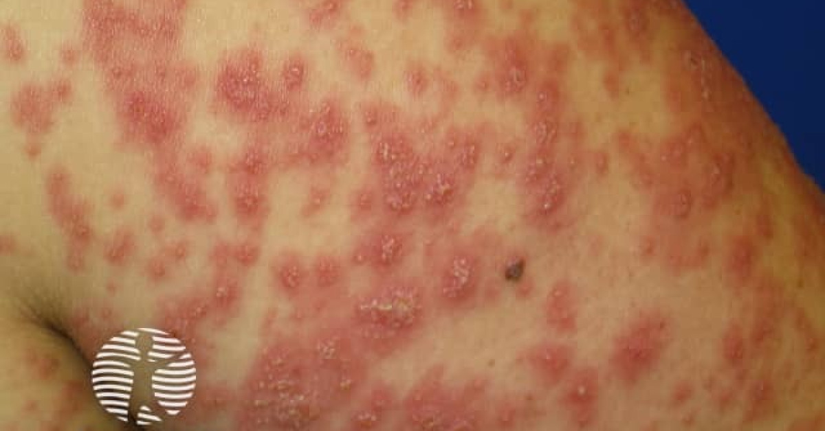 Clinical image of AGEP