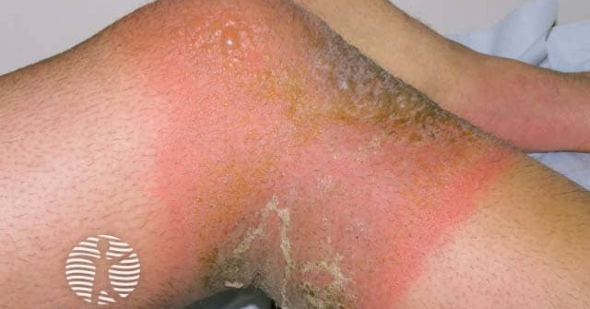 Clinical image of Allergic contact dermatitis