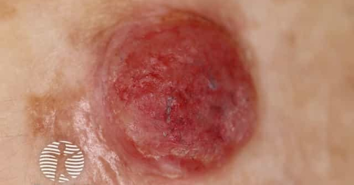 Clinical image of Amelanotic & hypopigmented melanoma
