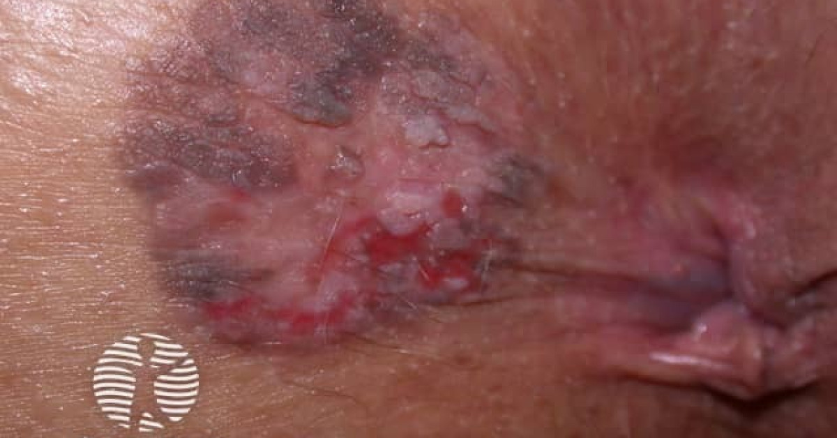 Clinical image of Anal intraepithelial neoplasia