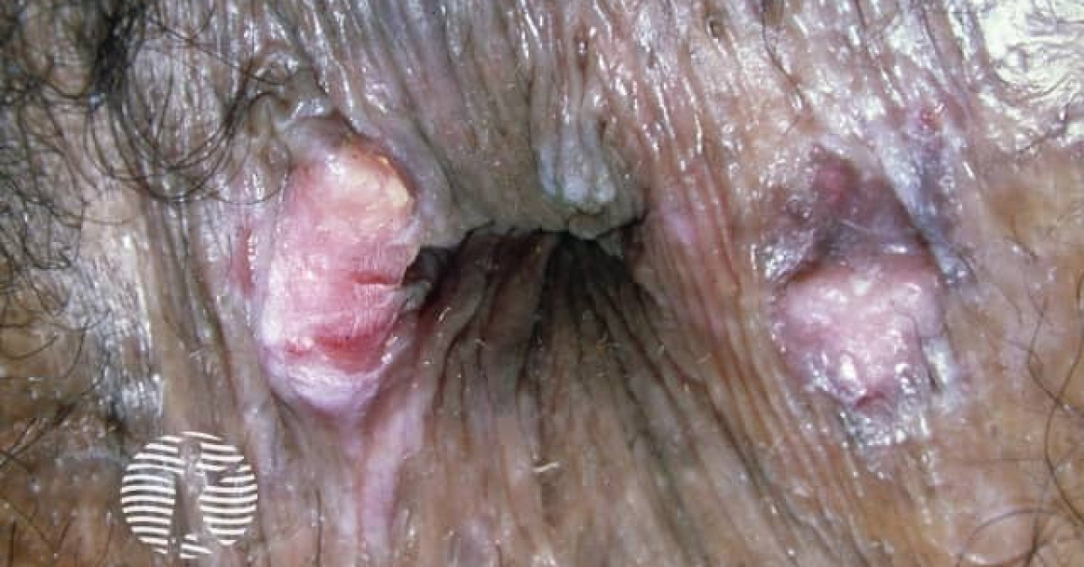 Clinical image of Anal squamous cell carcinoma
