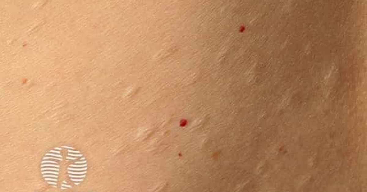 Clinical image of Anetoderma