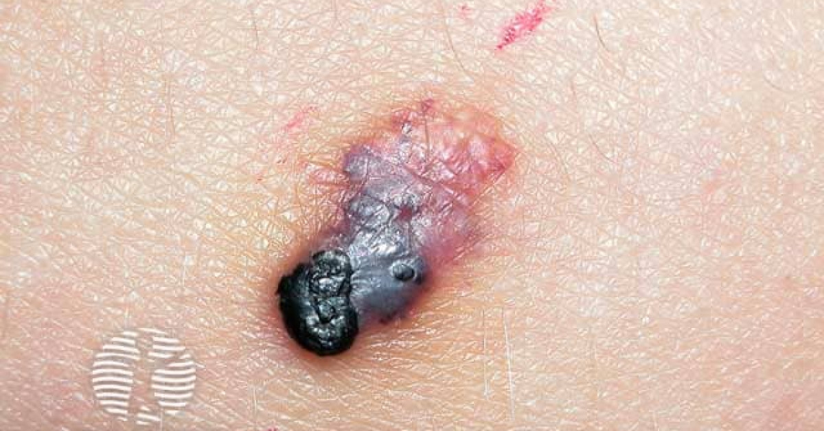 Clinical image of Angiokeratoma