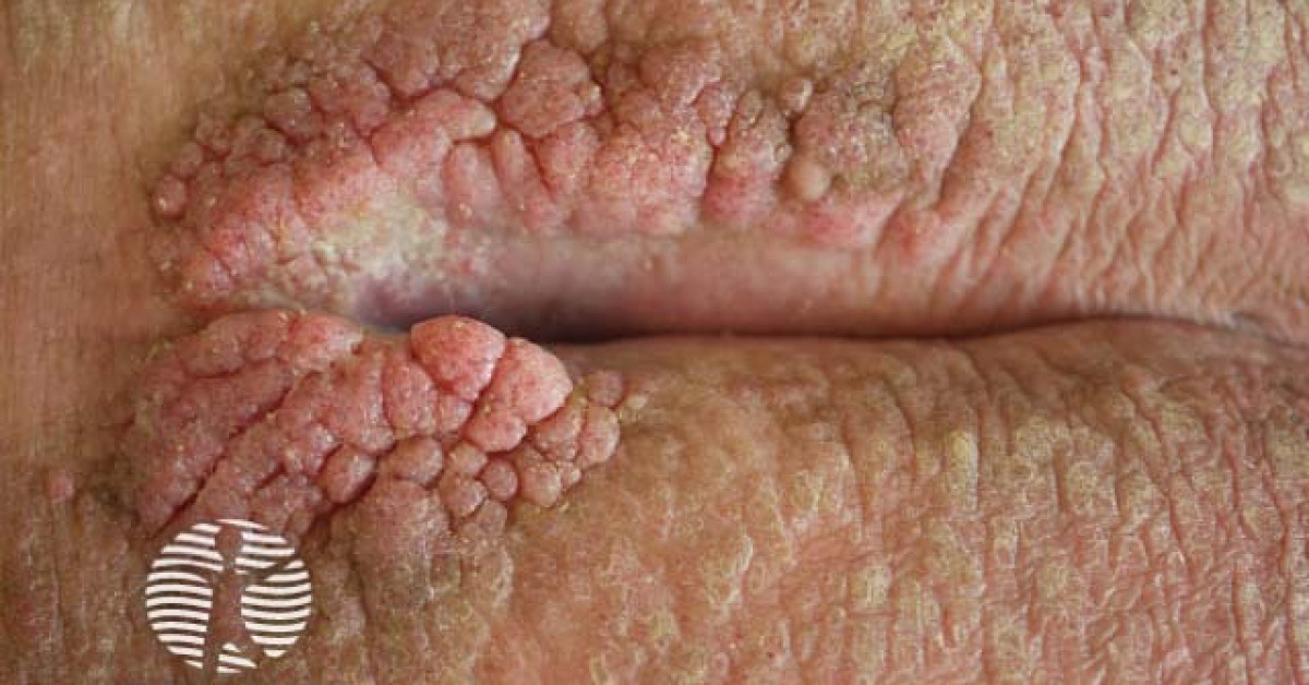 Clinical image of Anogenital warts