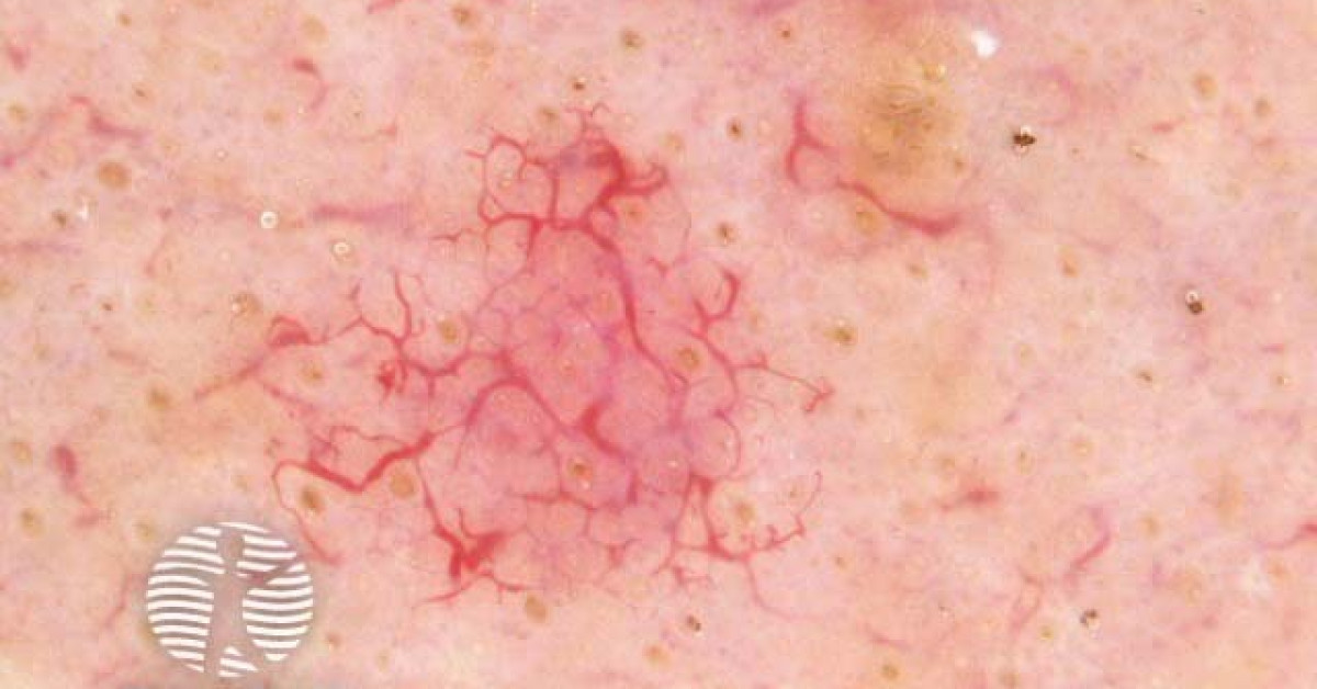 Clinical image of Ataxia-telangiectasia
