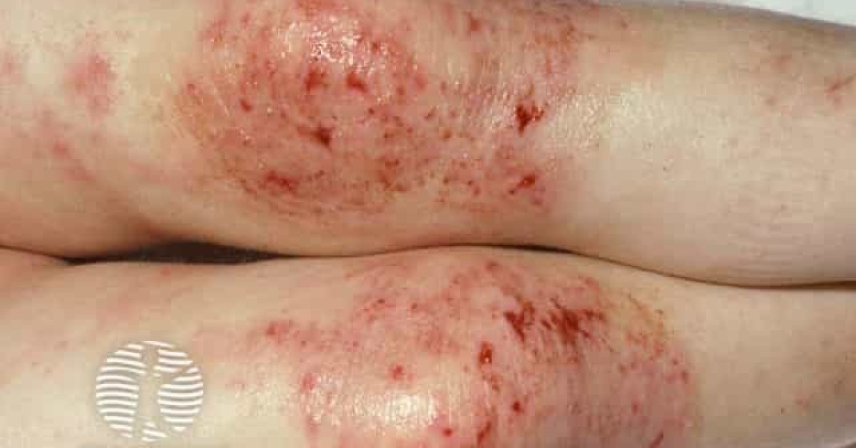 Clinical image of Atopic eczema