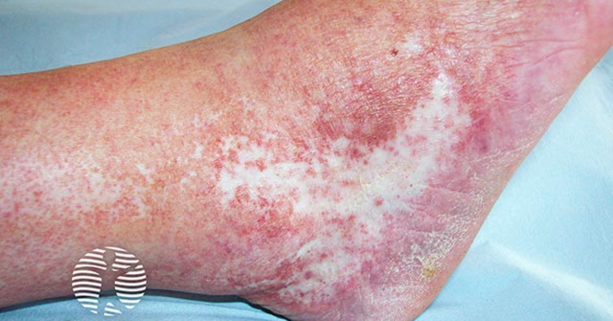 Clinical image of Atrophie blanche / livedoid vasculopathy