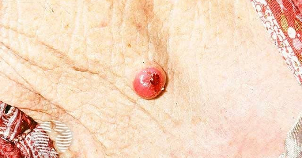 Clinical image of Atypical fibroxanthoma