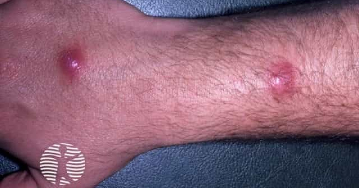 Clinical image of Atypical mycobacterial skin infection