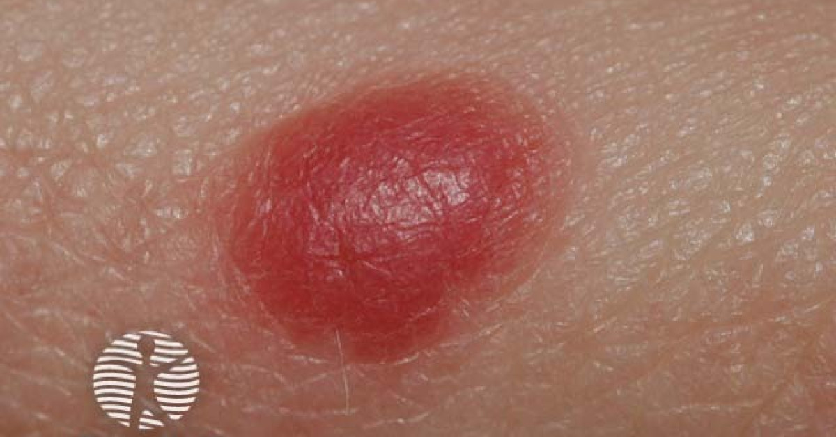 Clinical image of Atypical Spitz tumour / SAMPUS / MELTUMP