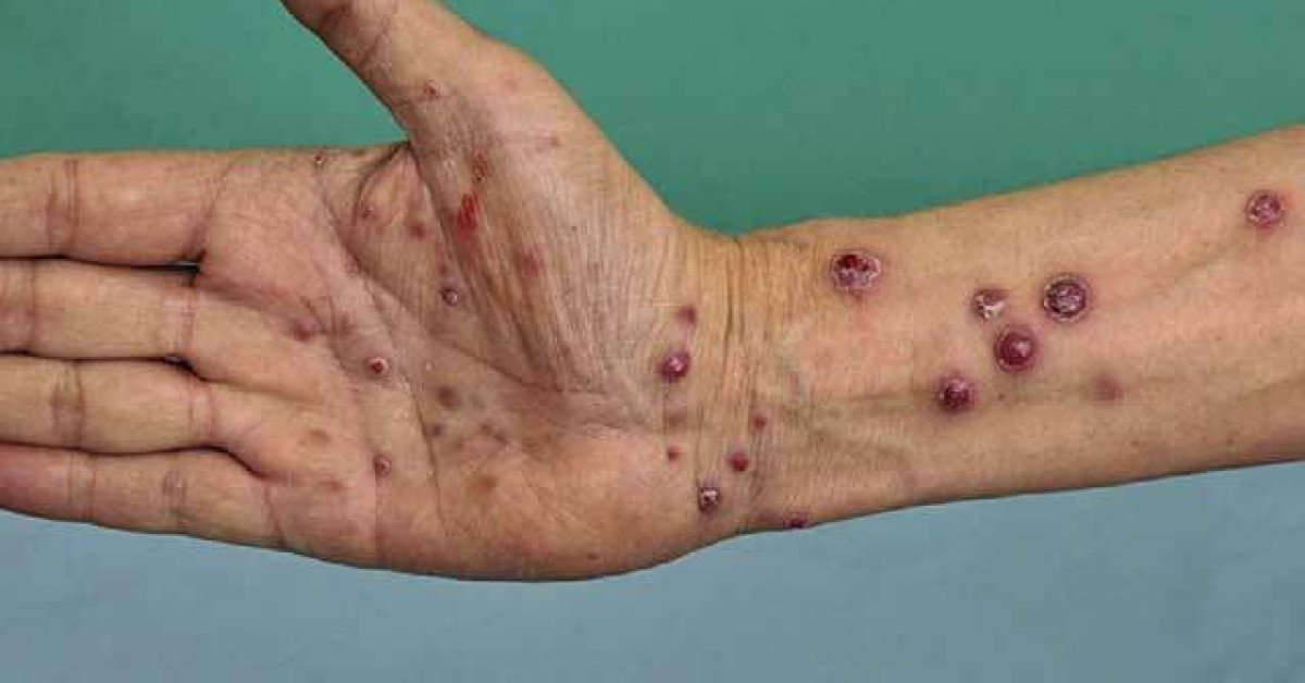 Clinical image of Bacillary angiomatosis