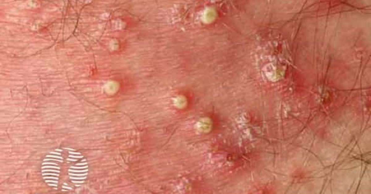 Clinical image of Bacterial folliculitis