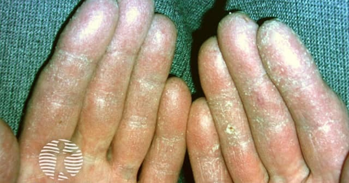 Clinical image of Bazex paraneoplastic acrokeratosis
