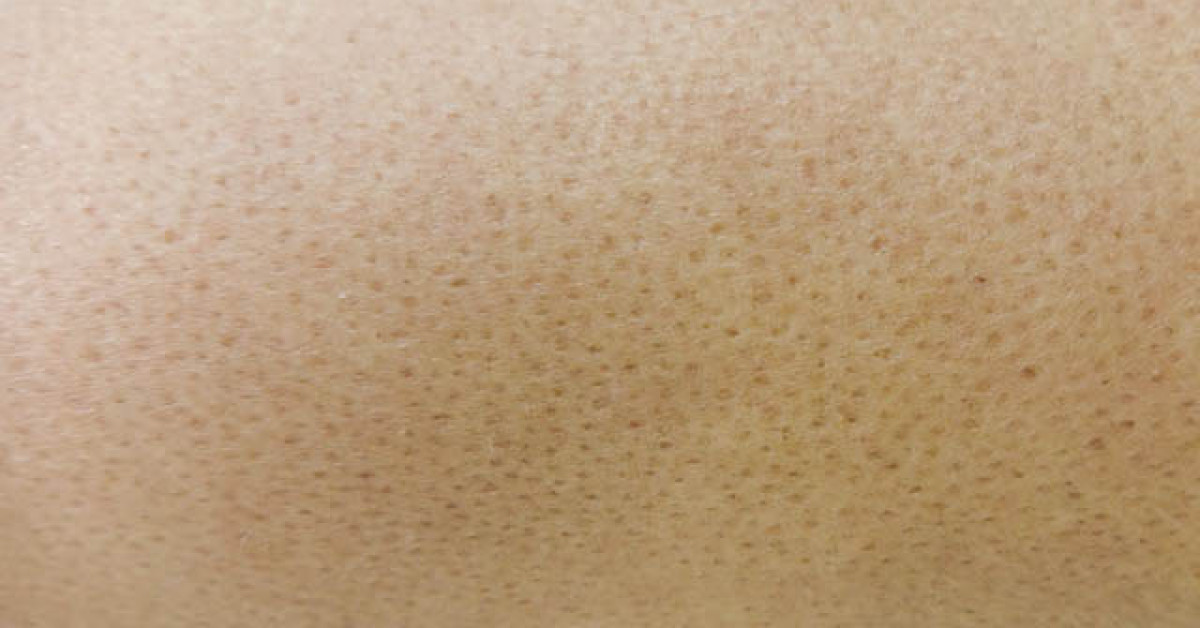 Clinical image of Bazex-Dupré-Christol syndrome