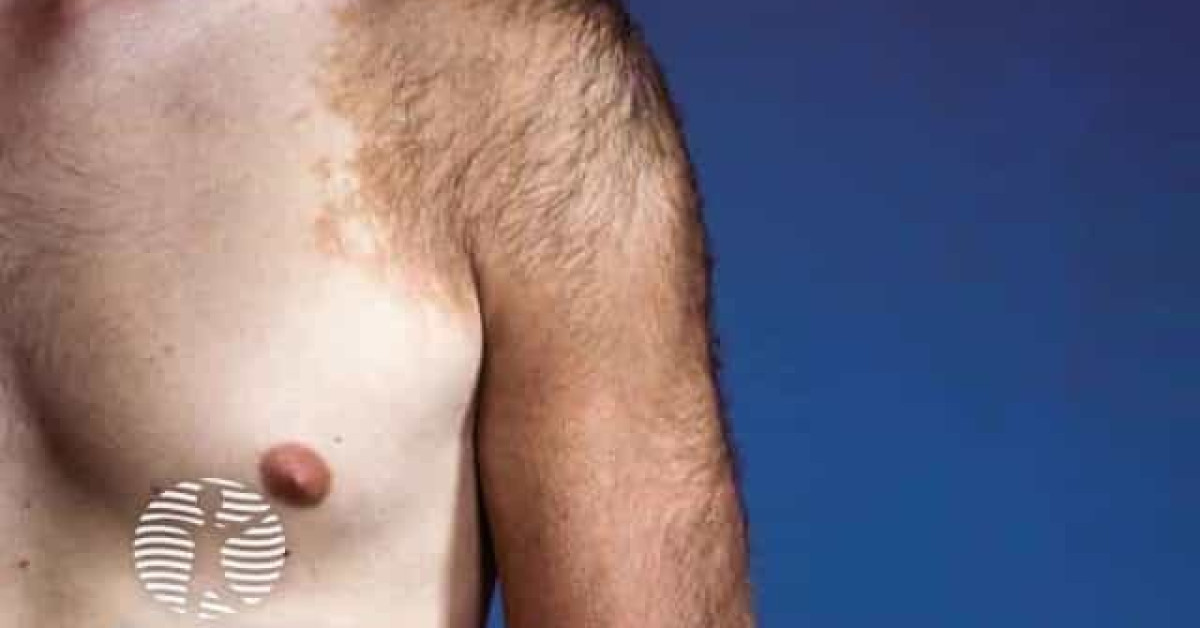 Clinical image of Becker naevus