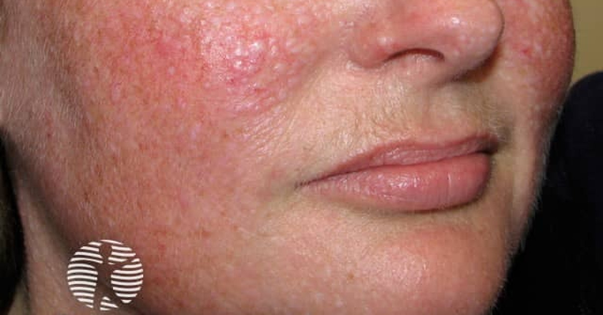 Clinical image of Birt-Hogg-Dubé syndrome