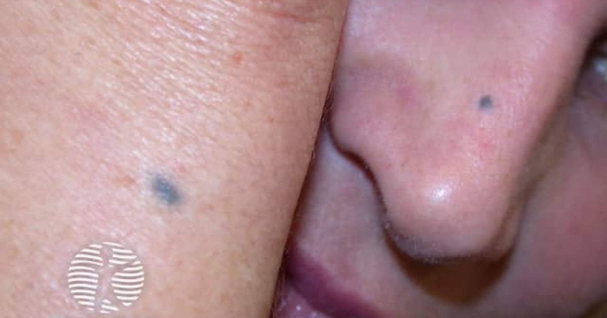 Clinical image of Blue naevus & CBN