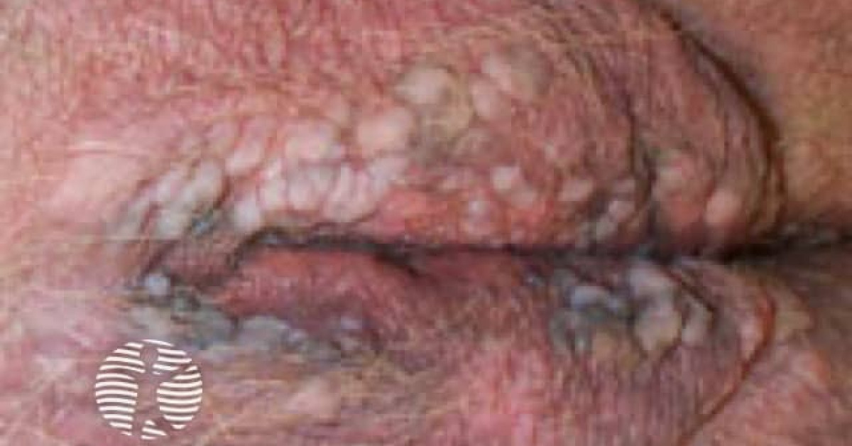 Clinical image of Bowenoid papulosis