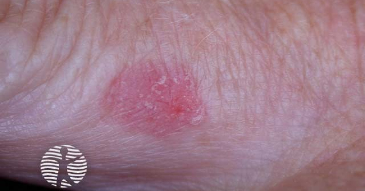 Clinical image of Bowen's disease