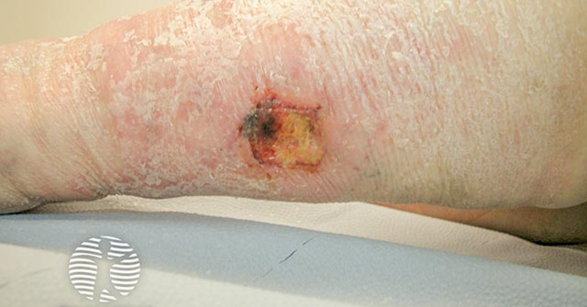 Clinical image of Calciphylaxis