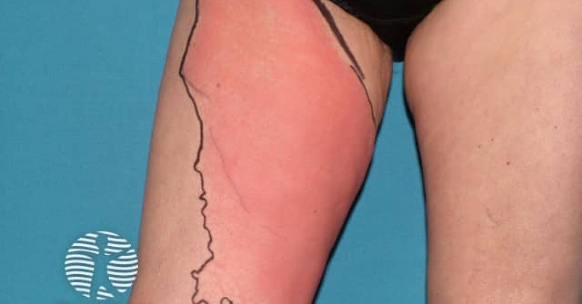 Clinical image of Cellulitis