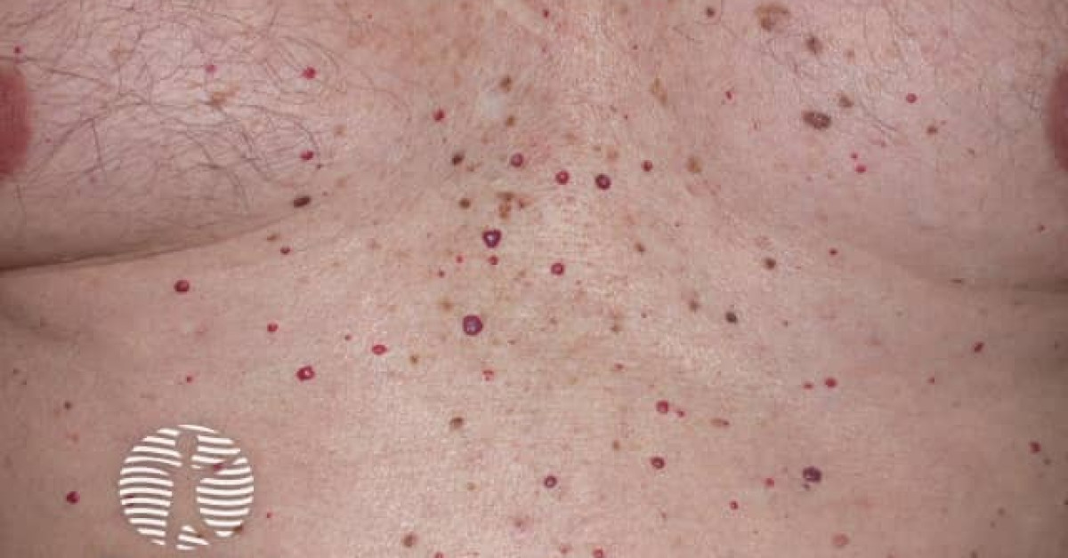 Clinical image of Cherry angioma