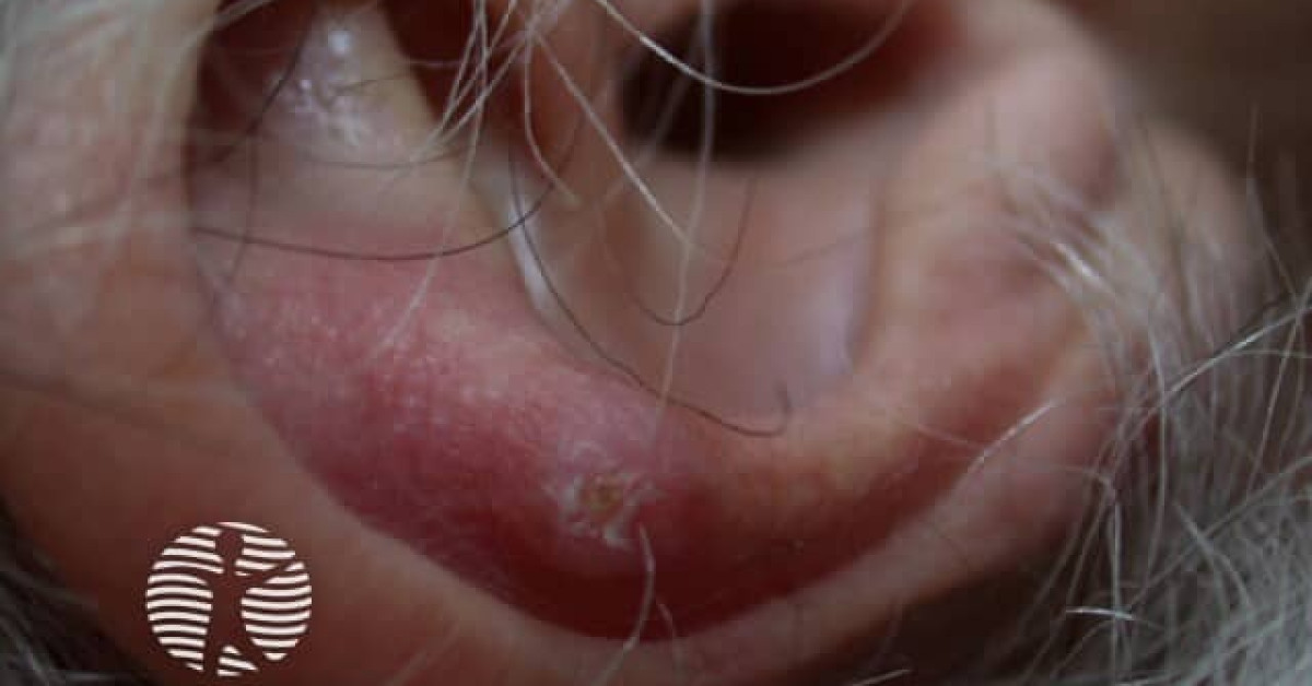 Clinical image of Chondrodermatitis nodularis helicis (CNH)