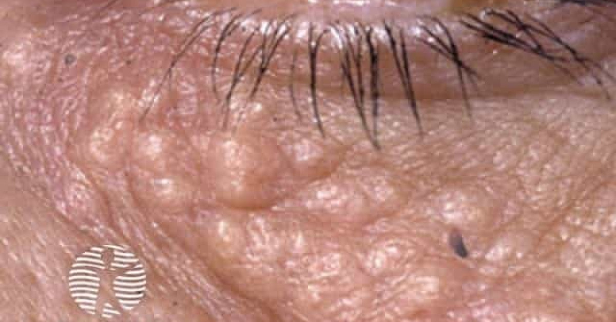 Clinical image of Chondroid syringoma