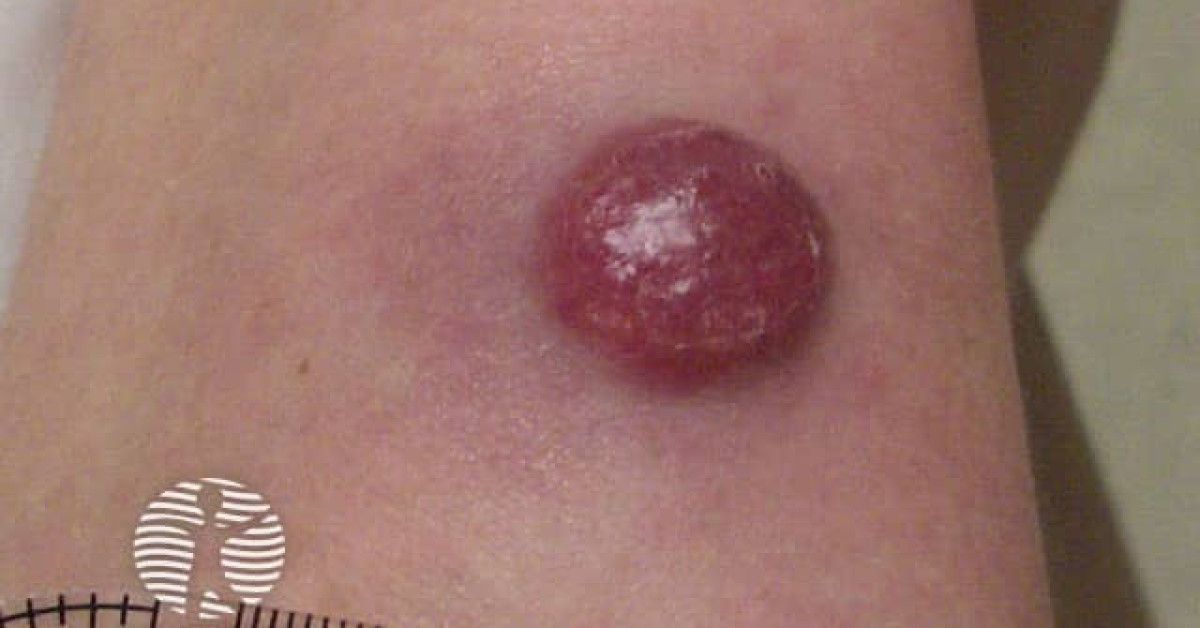 Clinical image of CK20 in Merkel cell carcinoma