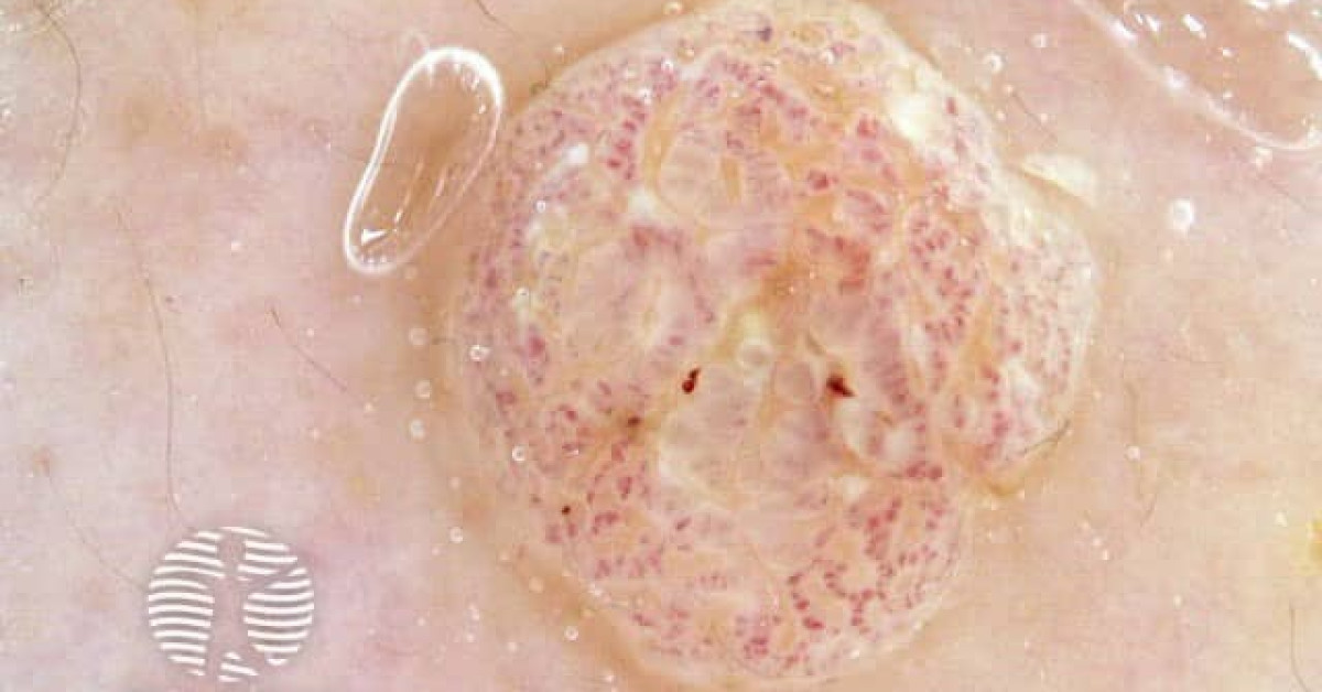 Clinical image of Clear cell acanthoma