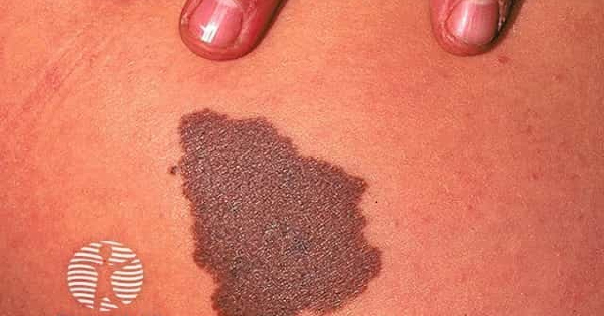Clinical image of Congenital melanocytic naevus