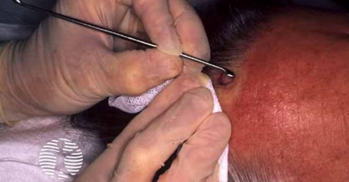 Clinical image of Curettage and cautery