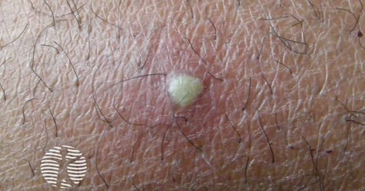 Clinical image of Cutaneous abscess / furunculosis